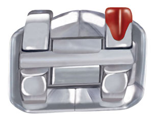 Traditional Metal Braces